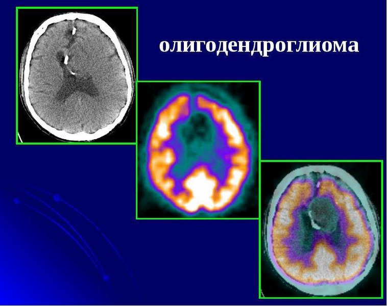 Разрешающая способность компьютерной томографии мозга имеет ограничения и не позволяет определить