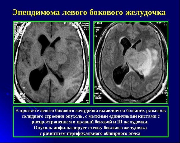 Образования желудочков мозга. Образования желудочков мозга кт. Опухоли 4 желудочка головного мозга мрт. Глиальная опухоль головного мозга кт протокол. Образование головного мозга кт.