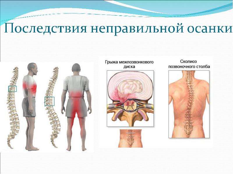 Последствия позвоночника. Последствия неправильной осанки. Плохая осанка последствия. Влияние осанки на здоровье человека. Неправильная осанка искривление позвоночника.