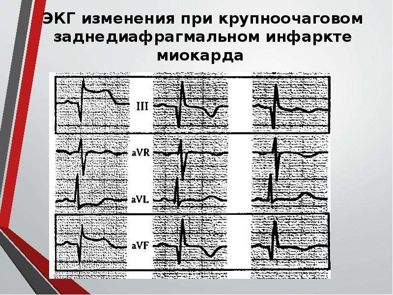 Очаговые изменения на экг. Крупноочаговый инфаркт на ЭКГ. Крупноочаговый заднедиафрагмальный инфаркт миокарда ЭКГ. Крупноочаговый инфаркт миокарда на ЭКГ. Мелкоочаговый инфаркт миокарда на ЭКГ.