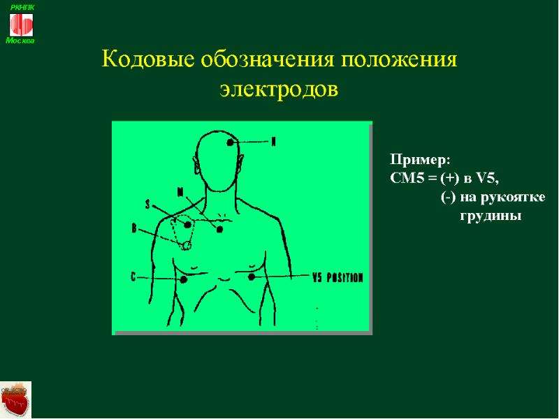 Холтер схема расположения электродов у женщин