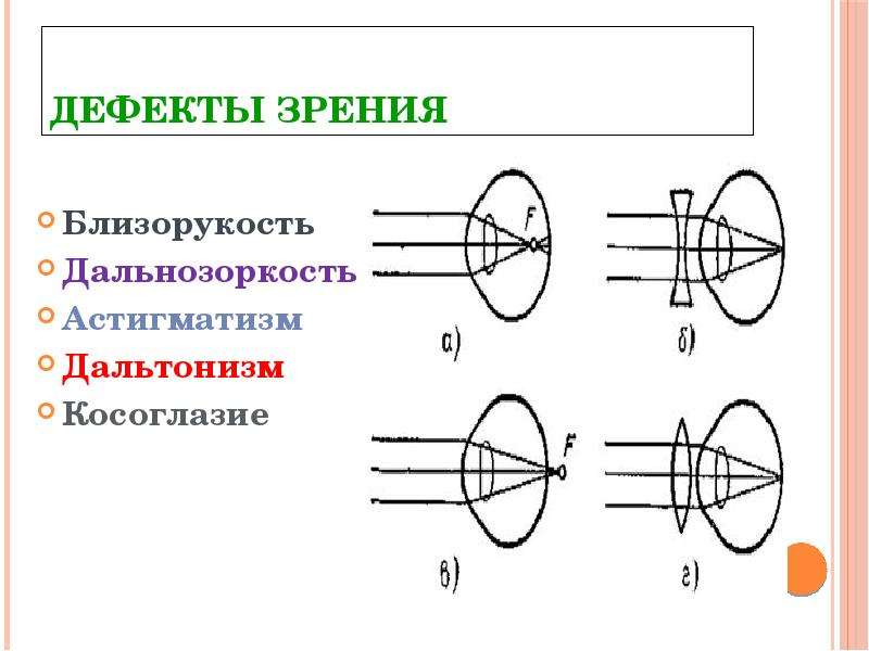 Что такое близорукость и дальнозоркость. Дефекты зрения дальнозоркость физика. Дефекты зрения близорукость. Понятие близорукости и дальнозоркости. Близорукость дальнозоркость астигматизм.