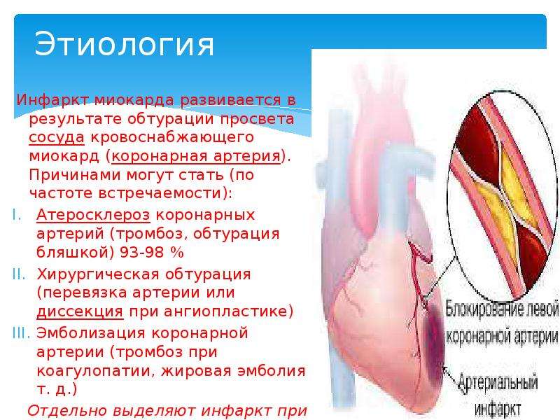 Презентации профилактика инфаркта миокарда