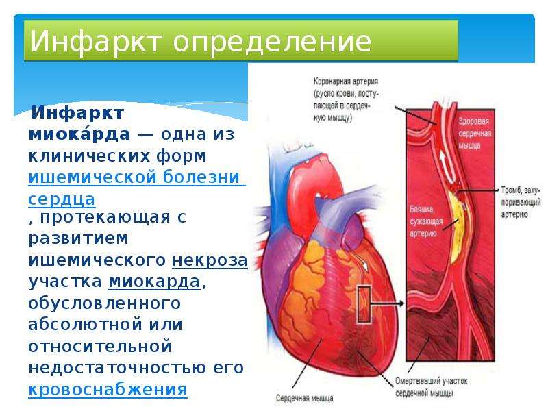Презентации профилактика инфаркта миокарда thumbnail