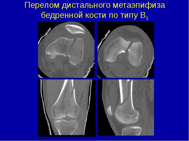 Метаэпифиз. Перелом в области дистального метаэпифиза бедренной кости. Детального метоэпифеза. Перелом дистального метаэпифиза бедренной кости у детей. Перелом дистального метаэпифиза большеберцовой кости кт.