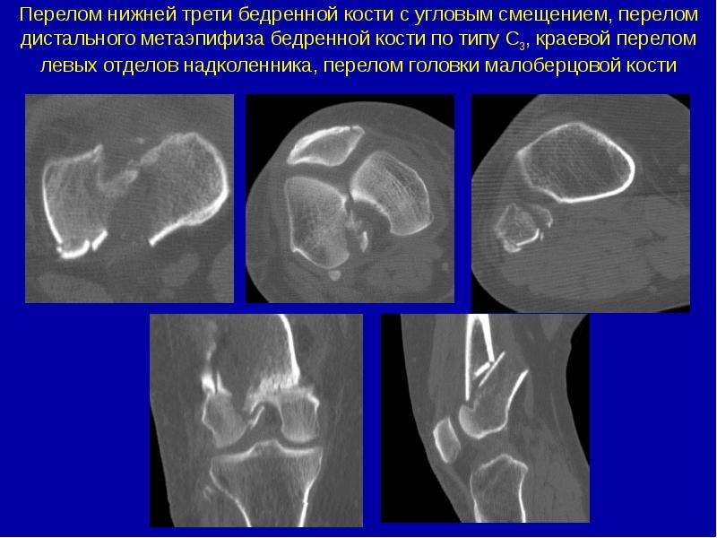 Карта вызова смп перелом бедренной кости