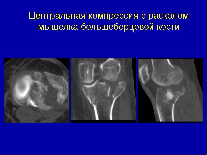 Некроз мыщелки. Асептический некроз коленного сустава рентген. Перелом мыщелка большеберцовой кости кт. Асептический некроз мыщелка большеберцовой кости. Импрессионный перелом мыщелка большеберцовой кости.