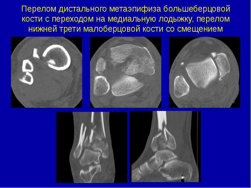 Метаэпифиз. Перелом дистального метаэпифиза большеберцовой кости. Перелом дистального метадиафиза большеберцовой кости. Перелом дистального нетроэпийиза. Детального метоэпифеза.