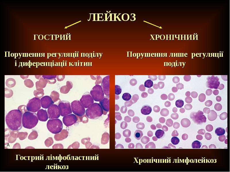 Презентация на тему лейкоз