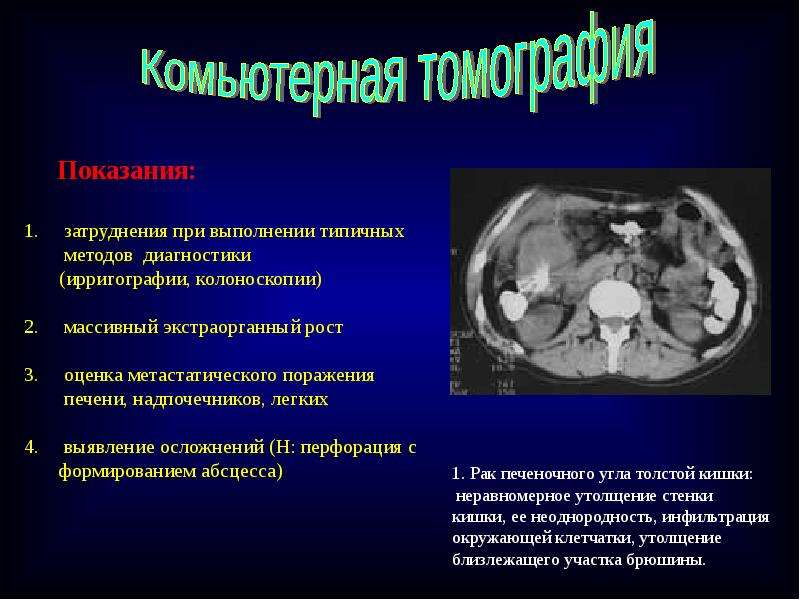 Циркулярное утолщение стенки толстой кишки