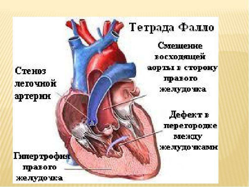 Как выглядит порок сердца на картинке