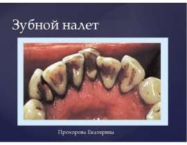 Зубной налет