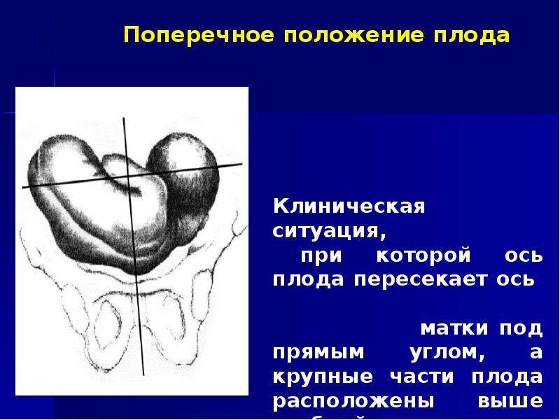 Неправильное положение плода презентация