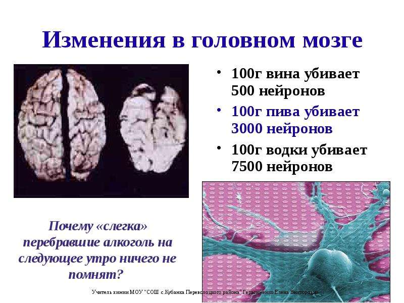 Изменения в головном мозге 100г вина убивает 500 нейронов 100г пива убивает 3000 нейронов 100г водки