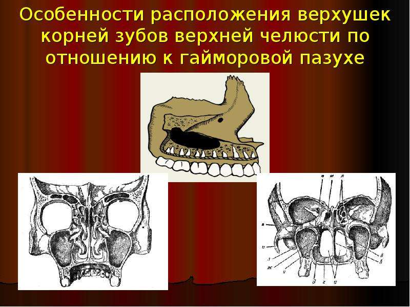 Верхней стенкой верхнечелюстной пазухи является верхней челюсти