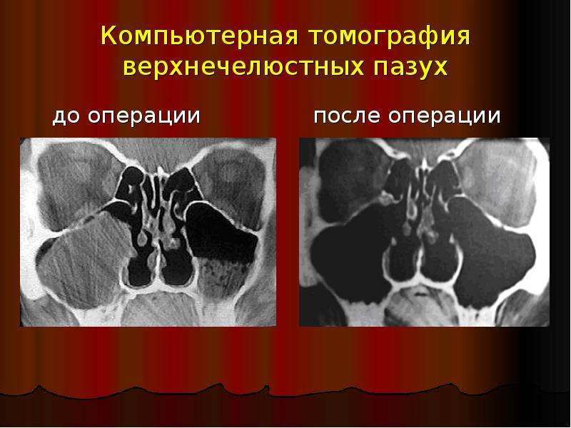 Разрушение стенки гайморовой пазухи