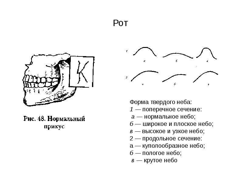 Форма неба. Форма свода твердого неба. Твердое небо это в логопедии. Твердое небо высокое узкое. Продольное сечение твердого неба.