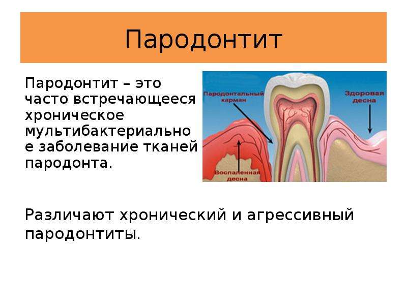 Состояние тканей пародонта. Пародонтит презентация. Заболевания пародонта презентация. Пародонтита презентация. К воспалительным заболеваниям пародонта относят.