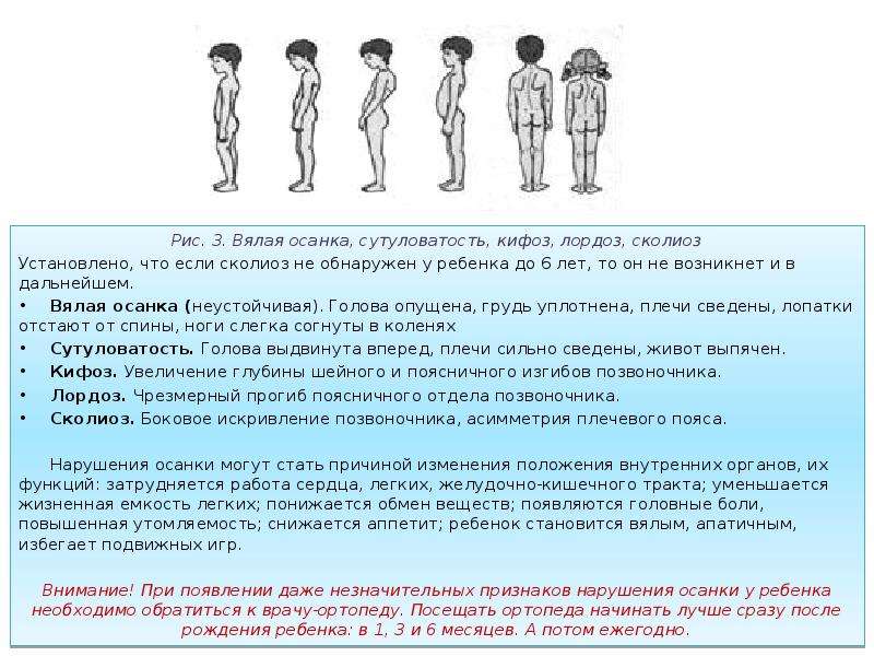 Профилактика нарушений осанки у детей дошкольного возраста презентация