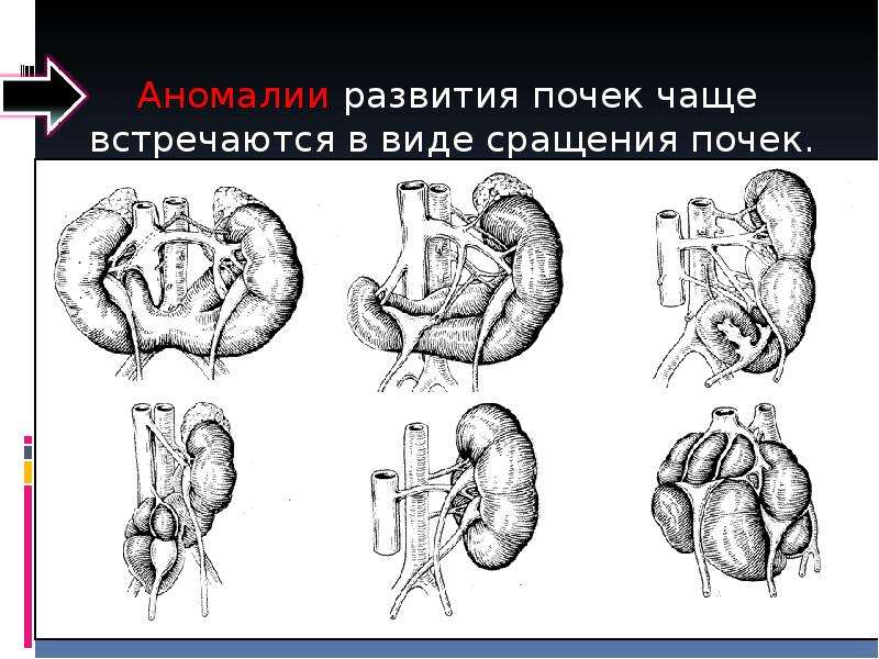 Поче у. Врожденные аномалии развития почек. Аномалия развития почек удвоение. Аномалии расположения почек классификация. Врожденные пороки развития почек у детей.