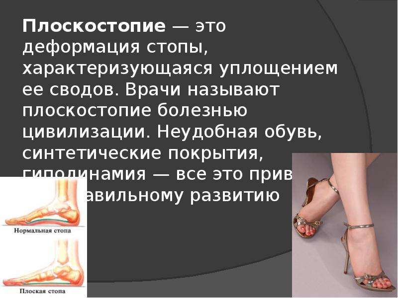 Презентация про плоскостопие