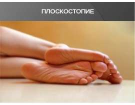Плоскостопие