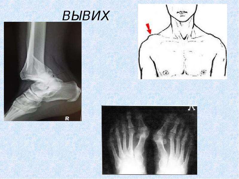 Вывих картинки для детей