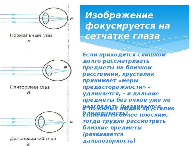 Если изображение фокусируется перед сетчаткой глаза возникает