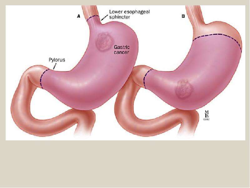 После удаления части желудка. Тотальная гастрэктомия анастомоз. Тотальная и субтотальная резекция желудка. Резекция желудка операция.