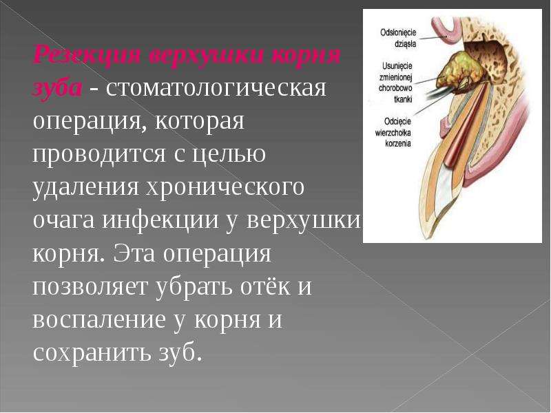 Схема резекции верхушки корня