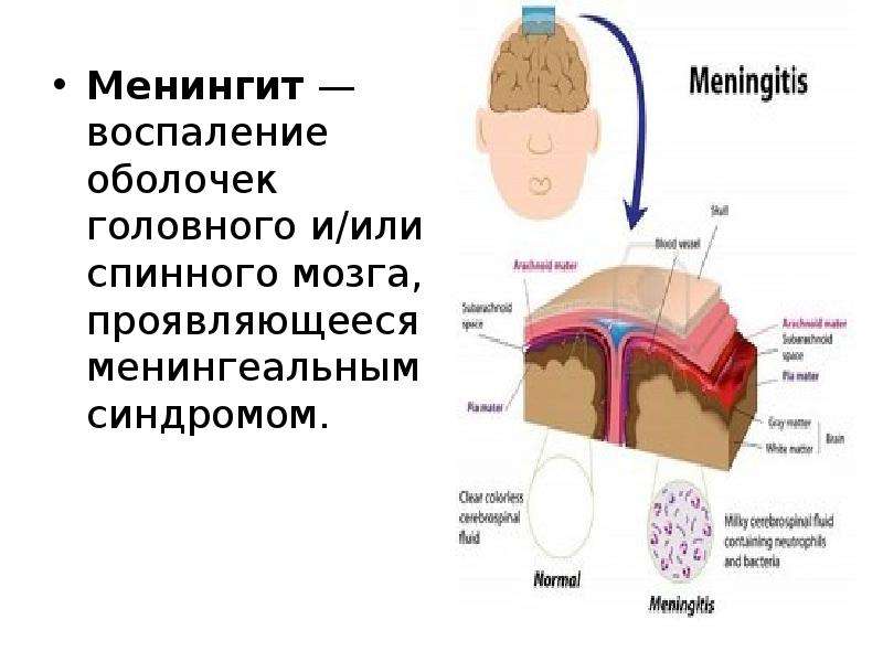 Менингококковый менингит презентация