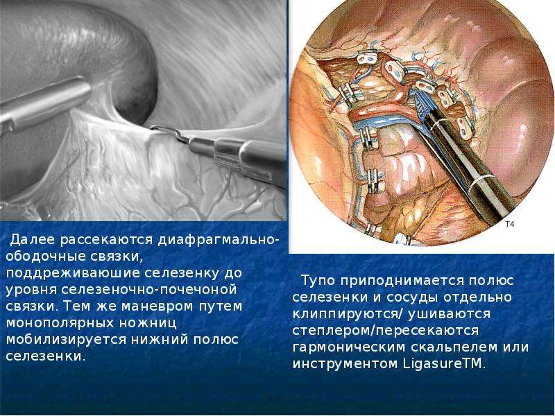 Особенности спленэктомии у гематологических больных, слайд 16
