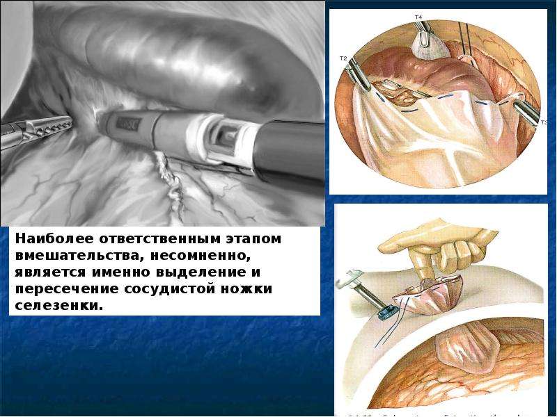 Особенности спленэктомии у гематологических больных, слайд 17
