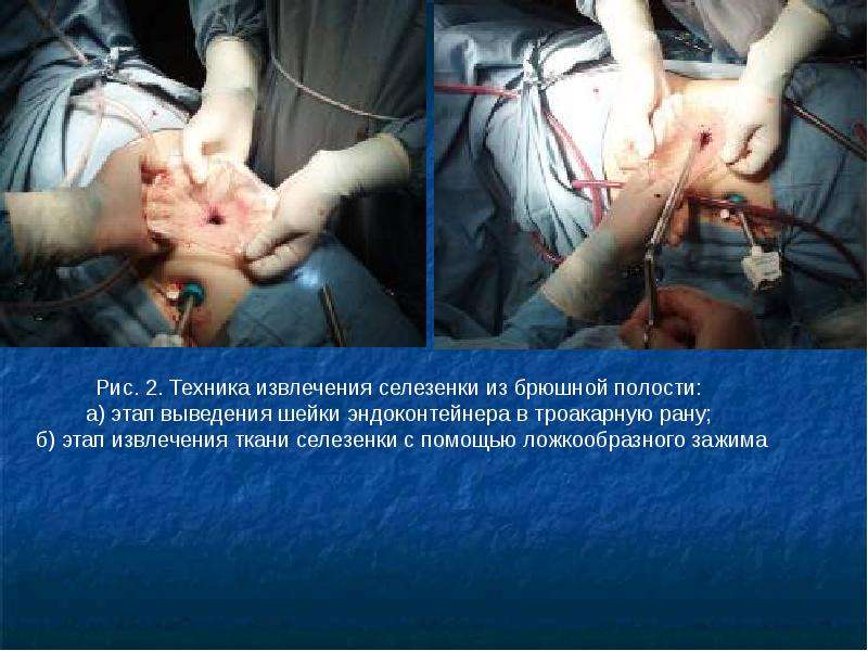 Особенности спленэктомии у гематологических больных, слайд 19