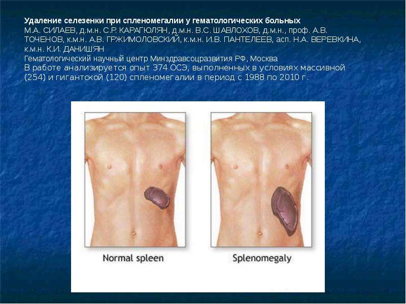Особенности спленэктомии у гематологических больных, слайд 25