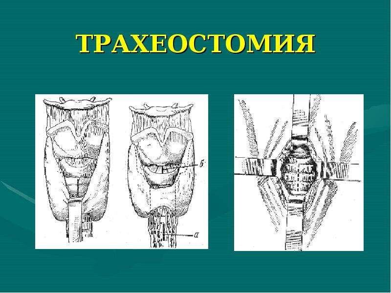 Трахеостомия