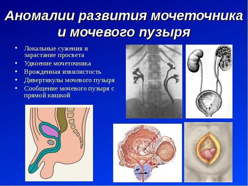 Пороки развития мочевого пузыря и уретры презентация