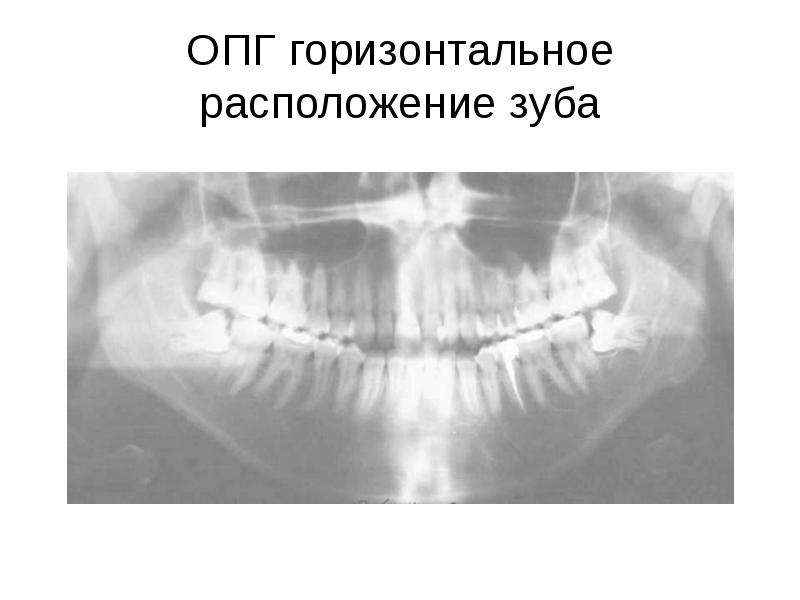 Болезни прорезывания зубов презентация