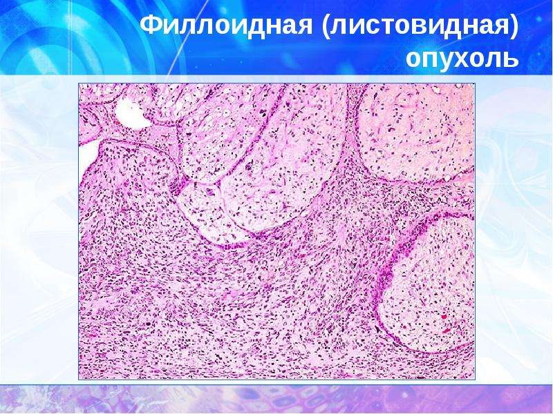 Молочная железа листовидная опухоль. Филлоидная фиброаденома гистология. Листовидная фиброаденома гистология. Филлоидная (листовидная) опухоль. Филлоидная фиброаденома молочной железы.