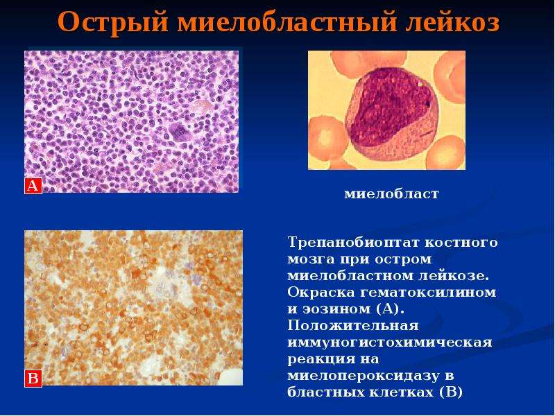 Лечение миелобластного лейкоза. Острый лимфобластный лейкоз гистология. Хронический миелобластный лейкоз костный мозг гистология. Хронический миелоидный лейкоз гистология. Острый миелолейкоз микропрепарат крови.
