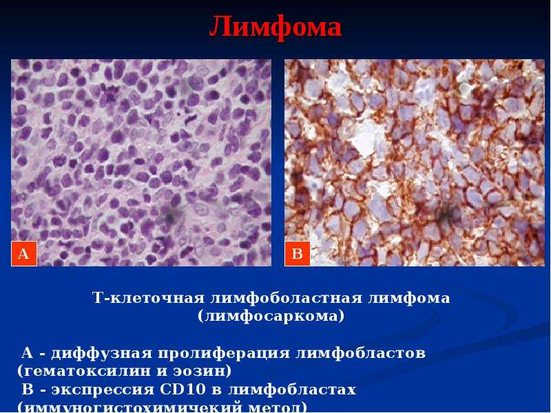 Диффузная крупноклеточная в клеточная. Лимфосаркома патанатомия. В клеточная лимфобластная лимфома. Крупноклеточная лимфома гистология. Диффузная лимфоцитарная лимфосаркома.