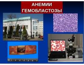 Анемии гемобластозы