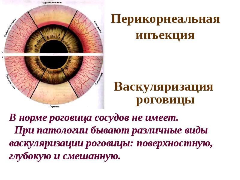 Уколы в глаза при дистрофии сетчатки отзывы. Перикорнеальная инъекция склеры. Поверхностная васкуляризация роговицы. Перикорнеальная инъекция глазного яблока. Кератит васкуляризация.