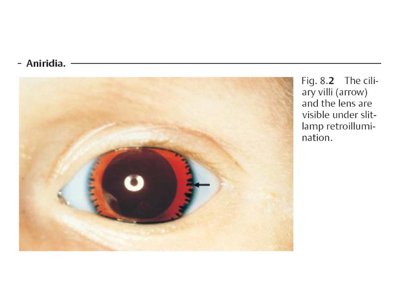 Афакия что это. Аниридия отсутствие Радужки.
