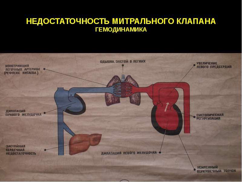 Митральные пороки презентация