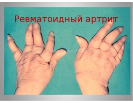 Ревматоидный артрит