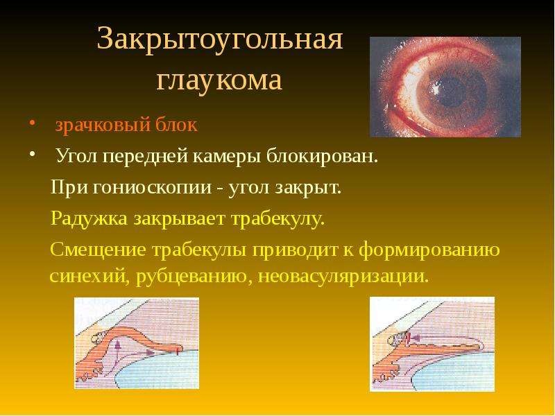 Открытоугольная глаукома картинки