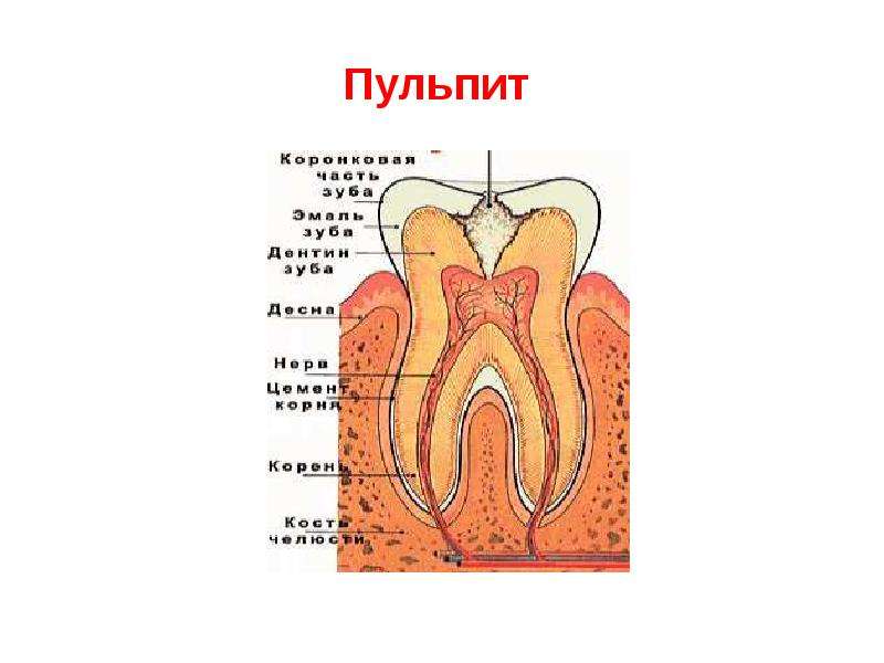 Воспаление пульпы зуба скачать