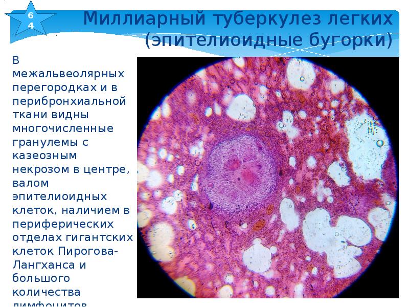 Клетки легких. Гранулема туберкулез микропрепарат. Туберкулезная гранулема гистология. Эпителиоидные клетки гранулемы. Казеозный некроз клетки Пирогова-Лангханса.