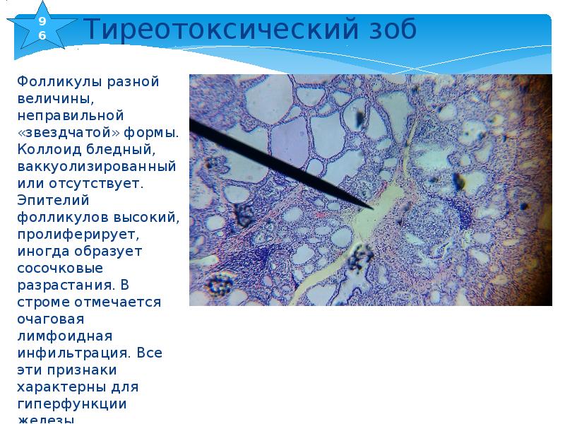 Эпителия без подлежащей стромы. Лимфоидная инфильтрация стромы. Очаговый инфильтрат лимфоидные фолликулы.